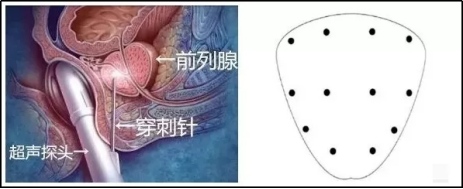罗甸县人民医院成功开展经直肠超声引导下前列腺穿刺活检术